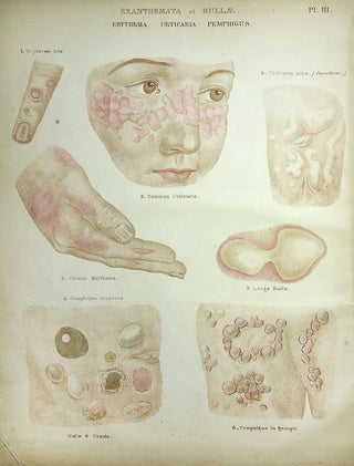 A Theoretical and Practical Treatise on the Diseases of the Skin